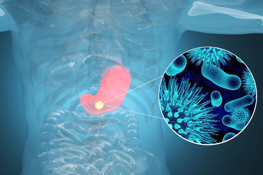 腫瘤標記物CA72-4：“胃”，你還好嗎？